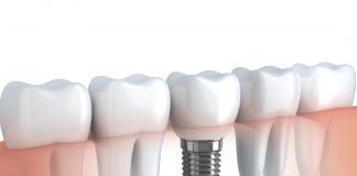 5 dúvidas sobre implantes