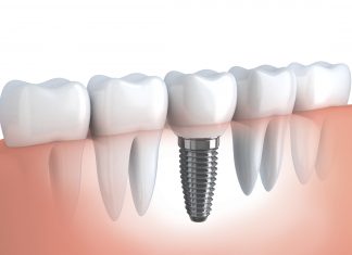 5 dúvidas sobre implantes