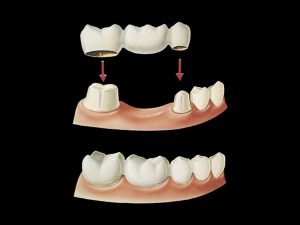 Fixa sobre dente